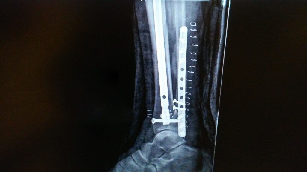 X-Ray of surgically repaired foot with the use of open reduction and internal fixation hardware